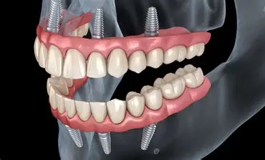 All-on-4 Behandlung für feste Zähne